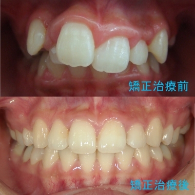 「歯並び、かみ合わせを良くすると頭が良くなる」との報告も - かみ合わせの改善は歯並びの改善から